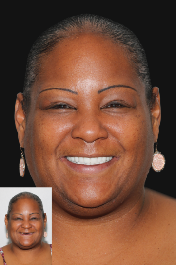 Patient before and after treatment at Revive Dental Implant Center