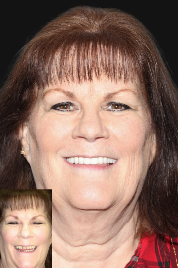 Patient before and after treatment at Revive Dental Implant Center